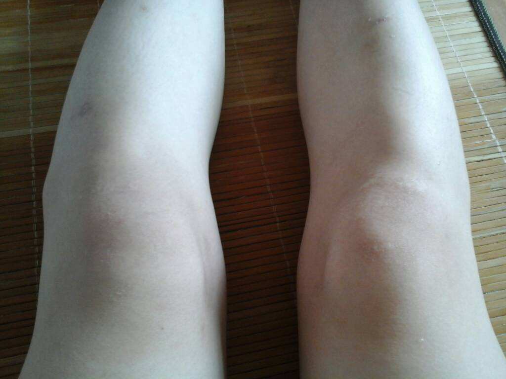 两周岁宝宝走路膝盖是直的吗 2岁宝宝走路膝盖弯曲怎么办