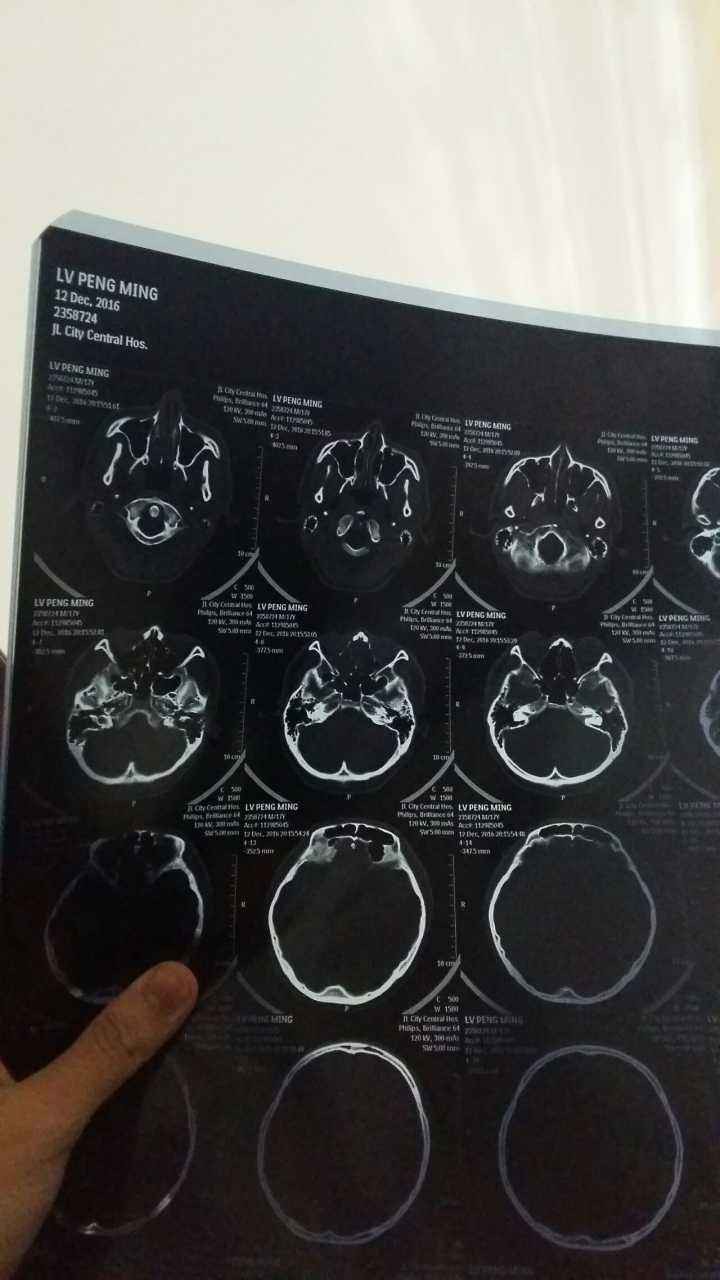 轻度脑震荡介绍 有什么症状呢