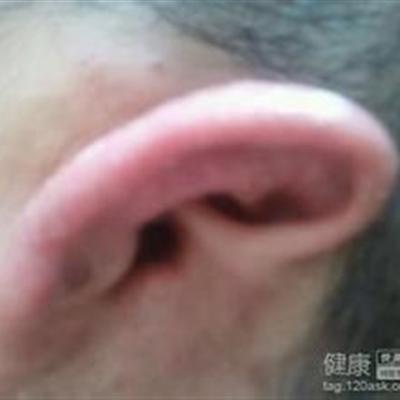 白癜風怎麽辦,第2張 白癜風怎麽辦,第2張